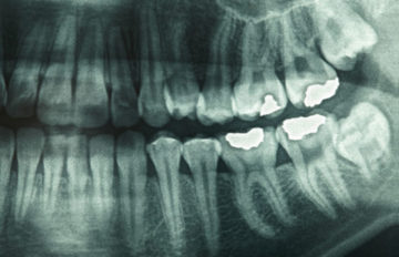 Dental x-rays Greensboro NC