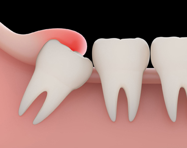 Problems with a Wisdom tooth and when you need to remove them