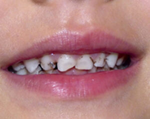 Your child's baby teeth are important and are still susceptible to cavities, even though they are temporary. Read more…