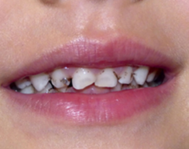 Your child's baby teeth are important and are still susceptible to cavities, even though they are temporary. Read more…