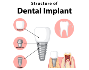 Dental Implants Greensboro, NC