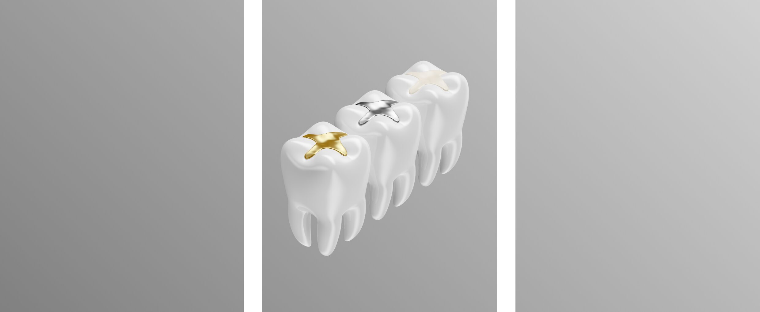 Tooth-Colored Fillings