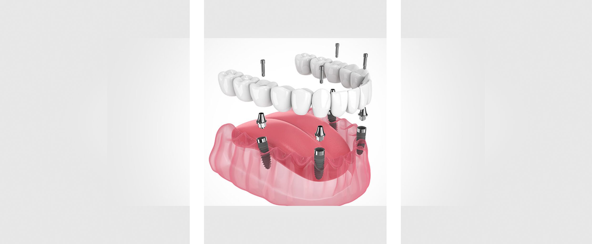 Implant-Supported Dentures