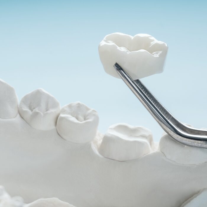 Dental Crowns