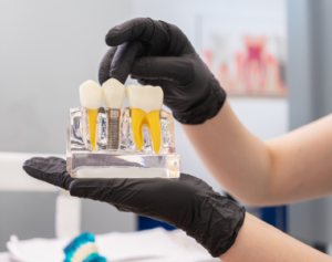 Dental Implant Process